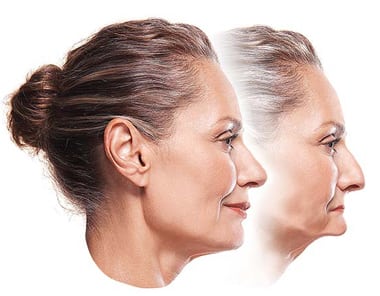Two side-by-side profile photos of a middle-aged woman with her normal facial appearance in the forefront and a facial collapse with sagging features in the background.