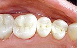 Mercury-free dentist after photo of lower molar teeth that had silver fillings replaced with composite.