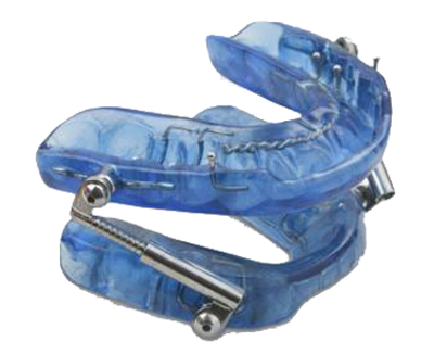 Photo of the a blue Herbst oral appliance with upper and lower trays that fit over the teeth and that are connected by side hinges.