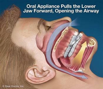 Diagram of a man sleeping and wearing a sleep apnea oral appliance that repositions his lower jaw; from Sugar Land dentist Dr. Siny Thomas.