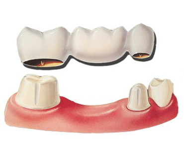 Diagram of a three-crown dental bridge for a comparison with an implant.