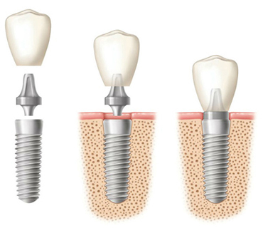 Diagram of a dental implant for comparison with a dental bridge.