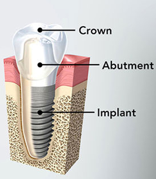 Diagram of dental implant components that must be properly placed to prevent implant failure, including the root form, abutment, and crown.