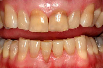 Before KoR whitening photo of dark stained teeth
