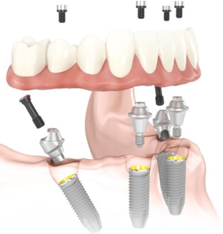 Diagram for Teeth-in-a-Day with a lower denture hovering above dental implants and ready to be screwed in.
