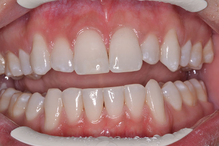 mans teeth after dental bonding
