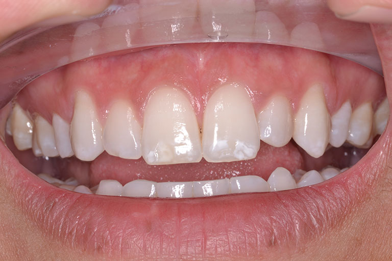 mans teeth before dental bonding