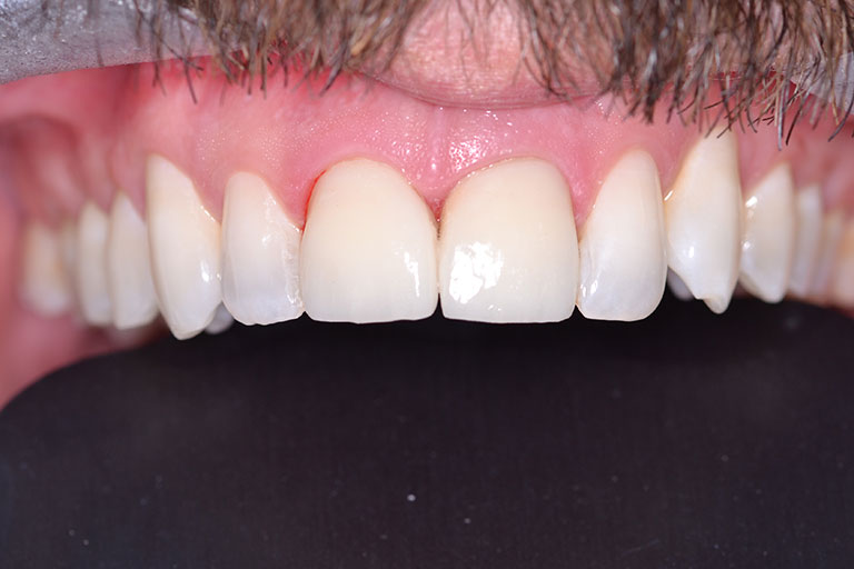 mans teeth with repaired fractured front tooth