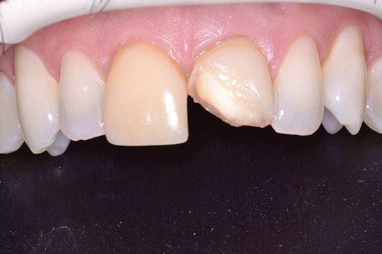 mans mouth showing fractured front tooth