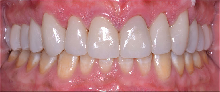 mans mouth smiling after full mouth rehab with straight teeth