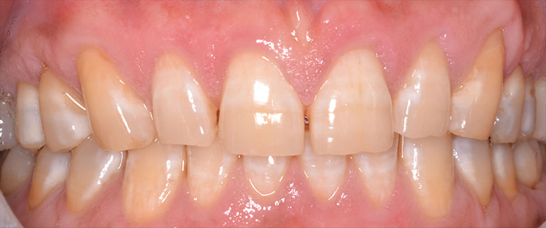 image of mans smile before much needed teeth rehab