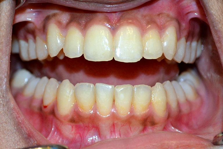 mans smile showing straight teeth after orthodontic work