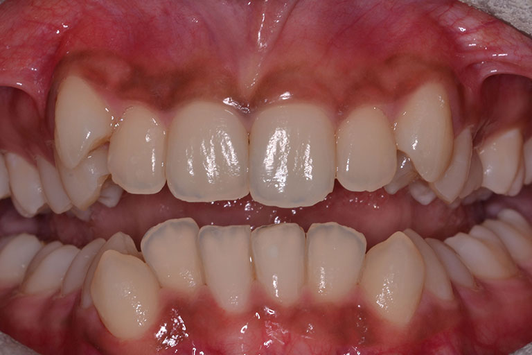 mans smile showing crooked teeth needing orthodontic work