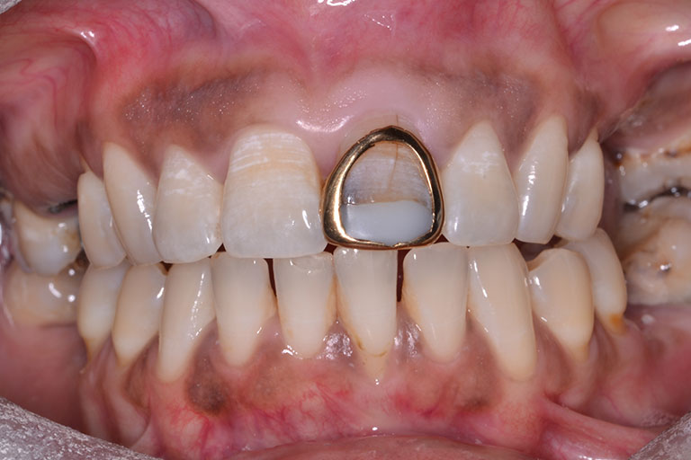 mans mouth showing gold crown needing replacement