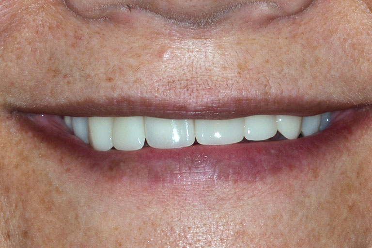 womans smile after makeover with straight white teeth