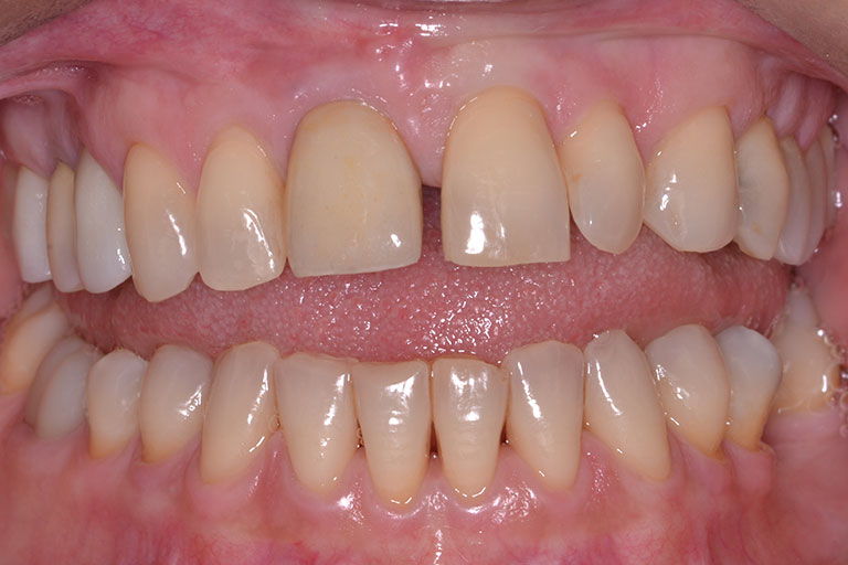 womans smile showing gapped discolored teeth