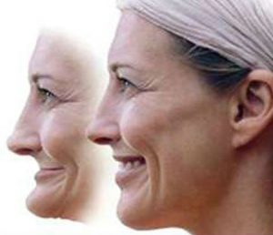 Illustration of facial collapse