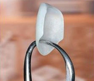 One porcelain veneer - available from Sugar Land cosmetic dentist Dr. Siny Thomas