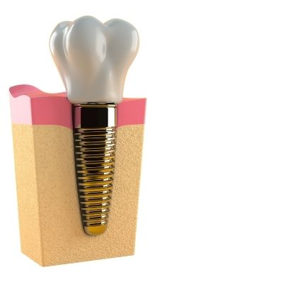 Diagram of a dental implant in the bone and gums