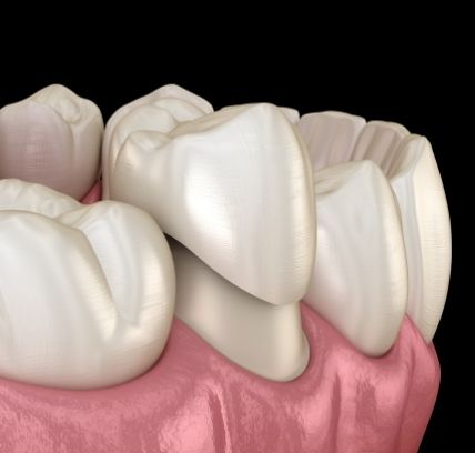 Diagram of a molar tooth with a temporary crown