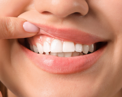 Close-up of a woman's smile and healthy gums and teeth, for information on gum recession and cavities