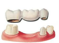 Diagram of a dental bridge hovering above tooth