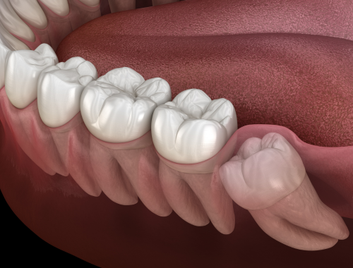 Diagram of an impacted wisdom tooth
