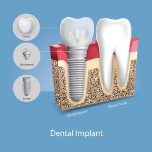 dental implants