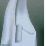 Maryland Bridge tooth preparation