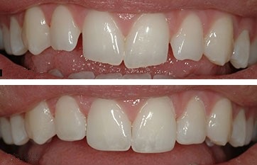 Composite bonding on front teeth
