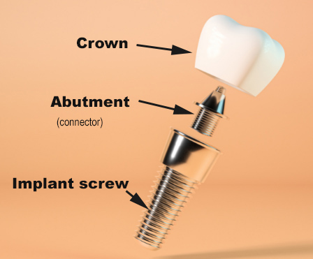 A dental implant with the crown, abutment, and implant screw labeled